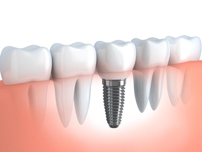 Dental Implants Bronxville, NY