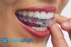 Invisalign: A Modern Way to Straighten Your Smile Without Traditional Braces