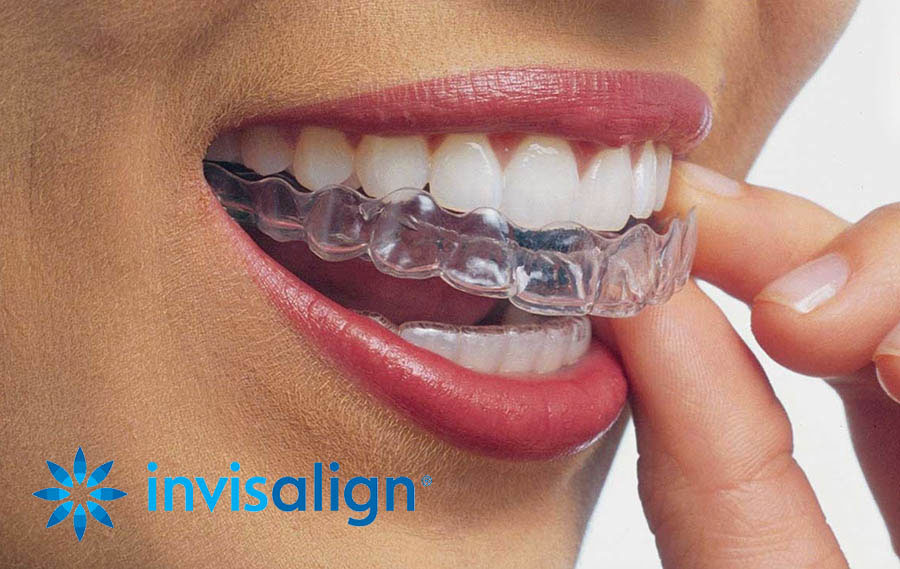 Invisalign: A Modern Way to Straighten Your Smile Without Traditional Braces